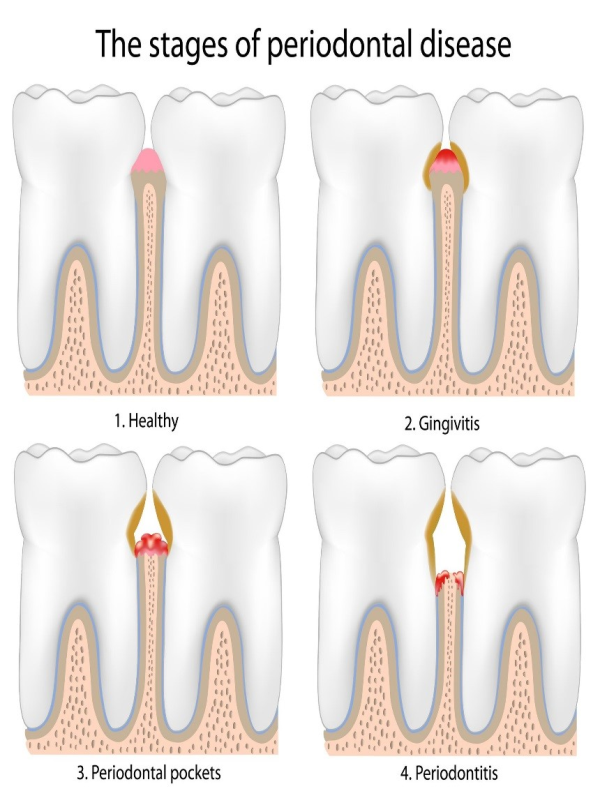 Stages of Periodontal Disease Corona, CA Green River Family Dentistry